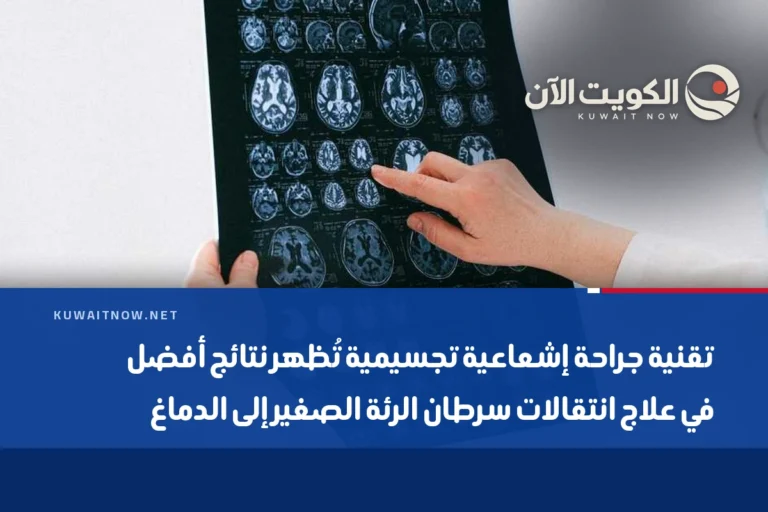 تقنية جراحة إشعاعية تجسيمية تُظهر نتائج أفضل في علاج انتقالات سرطان الرئة الصغير إلى الدماغ